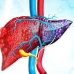 Karaciğer Yağlanması Neden Olur Ve Nasıl Geçer? Karaciğer Yağlanması Belirtileri ve Tedavisi