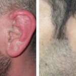 Sedef hastalarına, ev yoğurdu ve Akdeniz tipi beslenme tavsiyesi