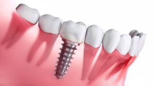 implant manisa