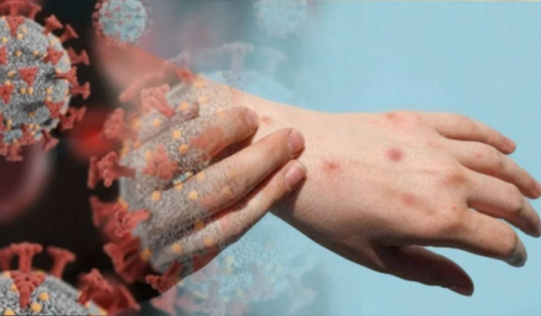 Kosova’da Maymun Çiçeği Alarmı!